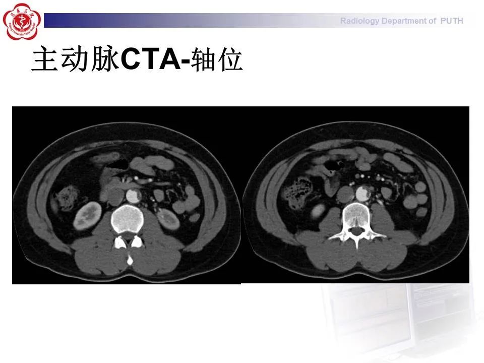 【PPT】主动脉夹层的影像