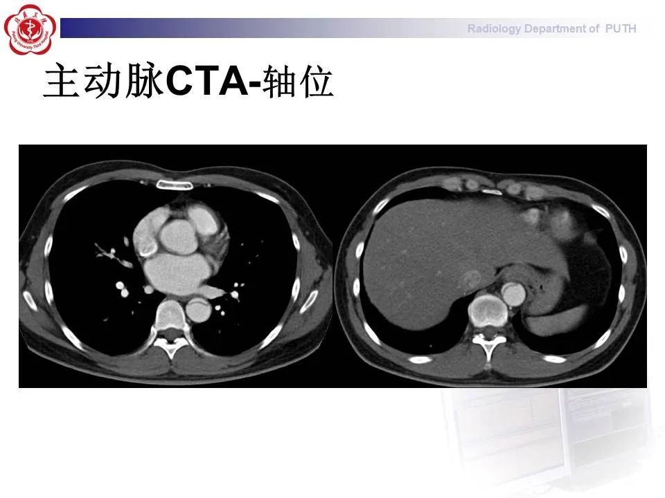 【PPT】主动脉夹层的影像