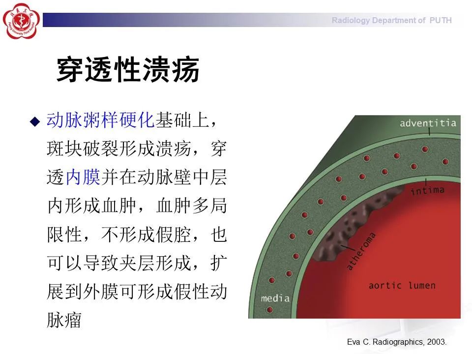 【PPT】主动脉夹层的影像