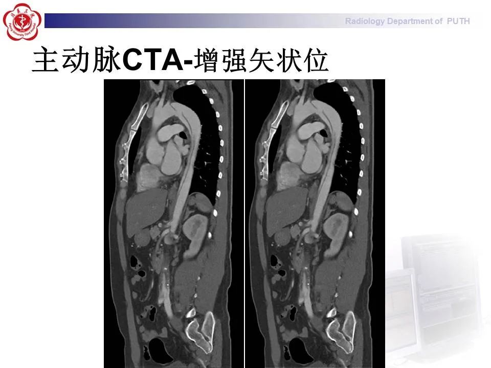 【PPT】主动脉夹层的影像