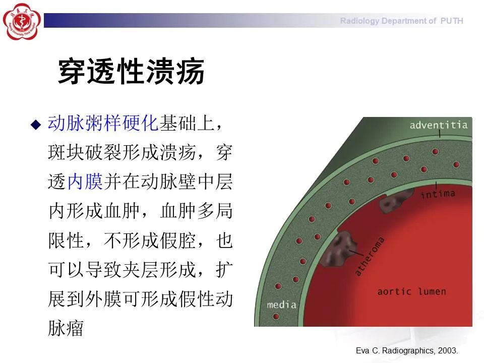 【PPT】主动脉夹层的影像