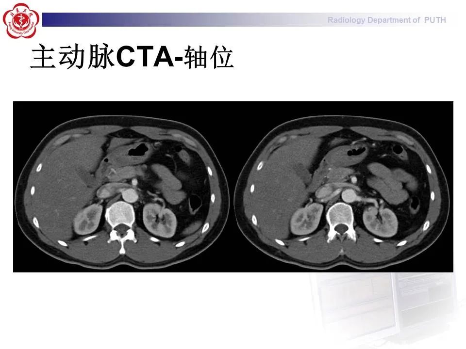 【PPT】主动脉夹层的影像