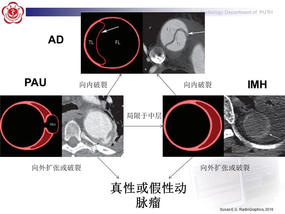 【PPT】主动脉夹层的影像