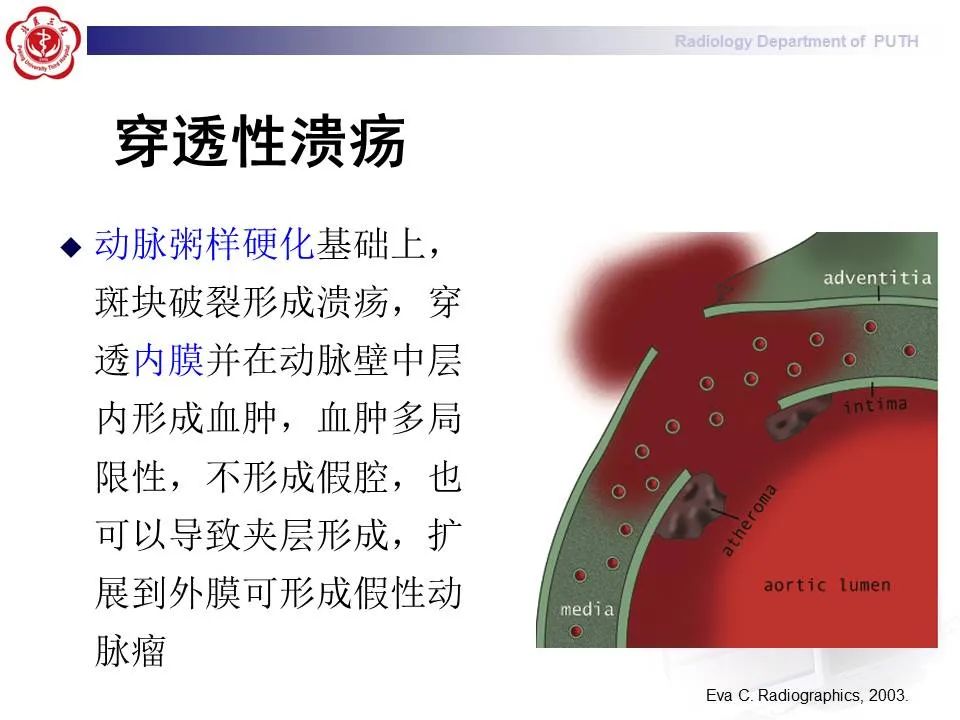 【PPT】主动脉夹层的影像