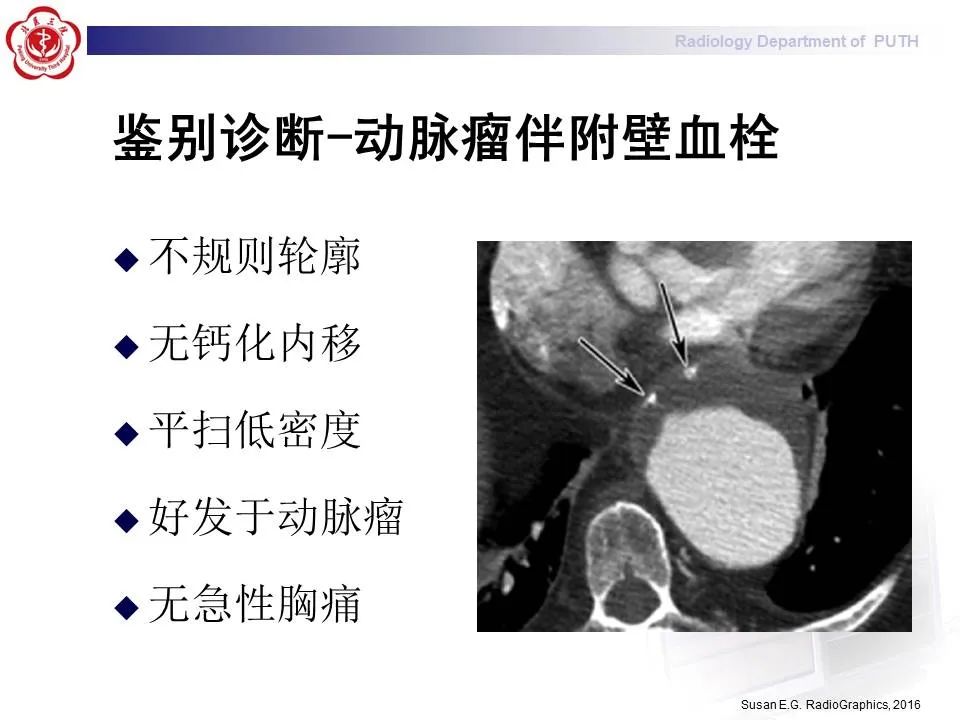 【PPT】主动脉夹层的影像