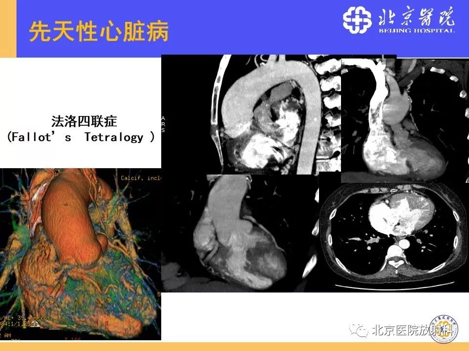 【PPT】心脏病变的影像诊断