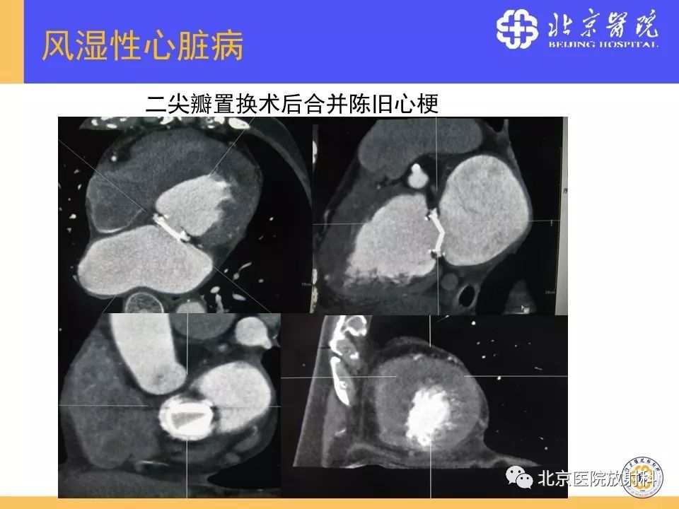 【PPT】心脏病变的影像诊断