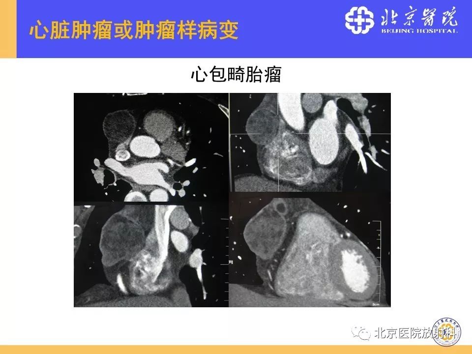 【PPT】心脏病变的影像诊断