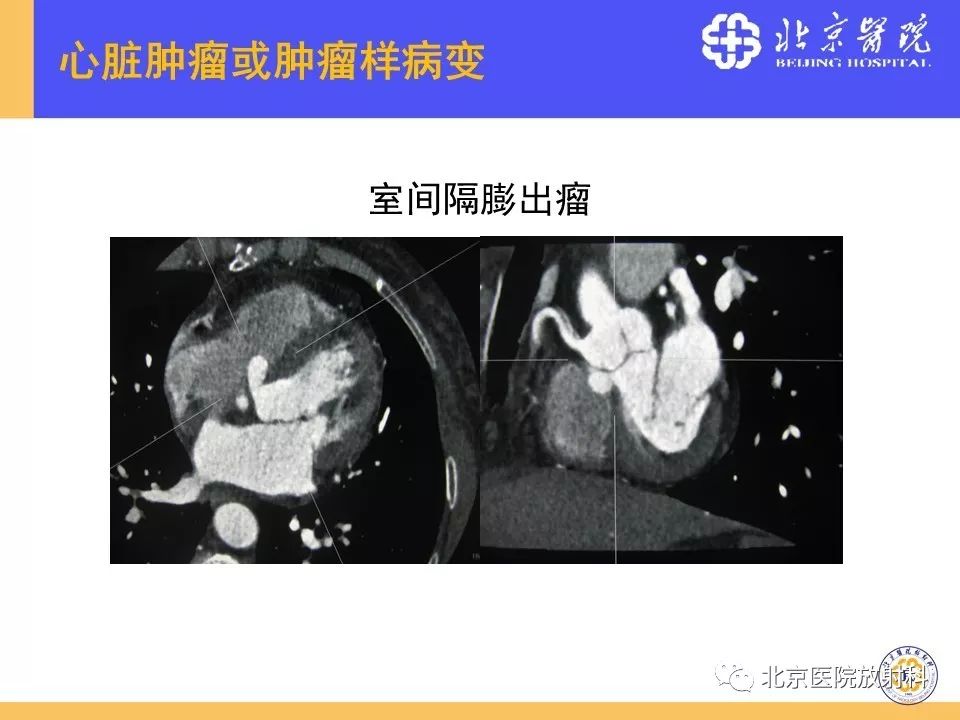 【PPT】心脏病变的影像诊断