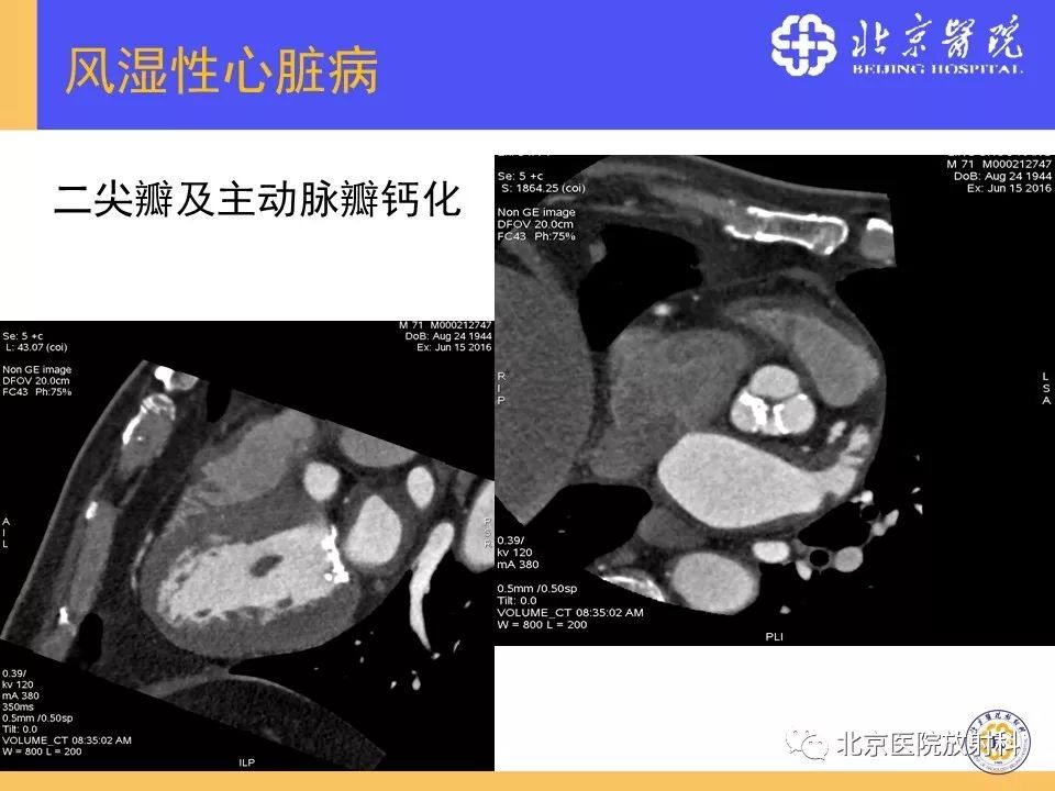 【PPT】心脏病变的影像诊断