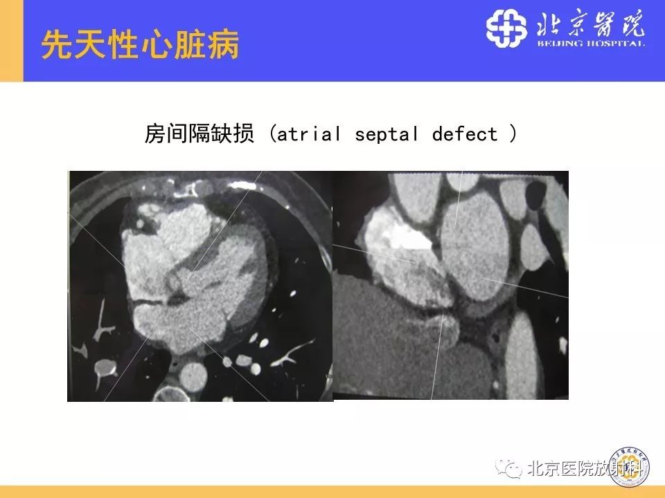 【PPT】心脏病变的影像诊断