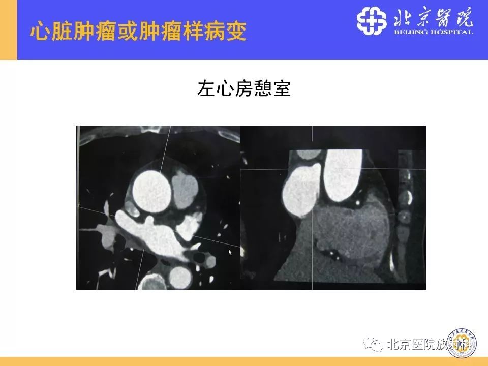【PPT】心脏病变的影像诊断