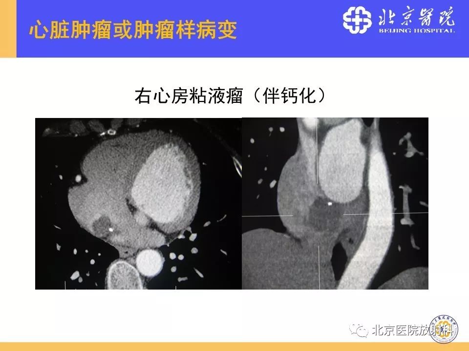 【PPT】心脏病变的影像诊断