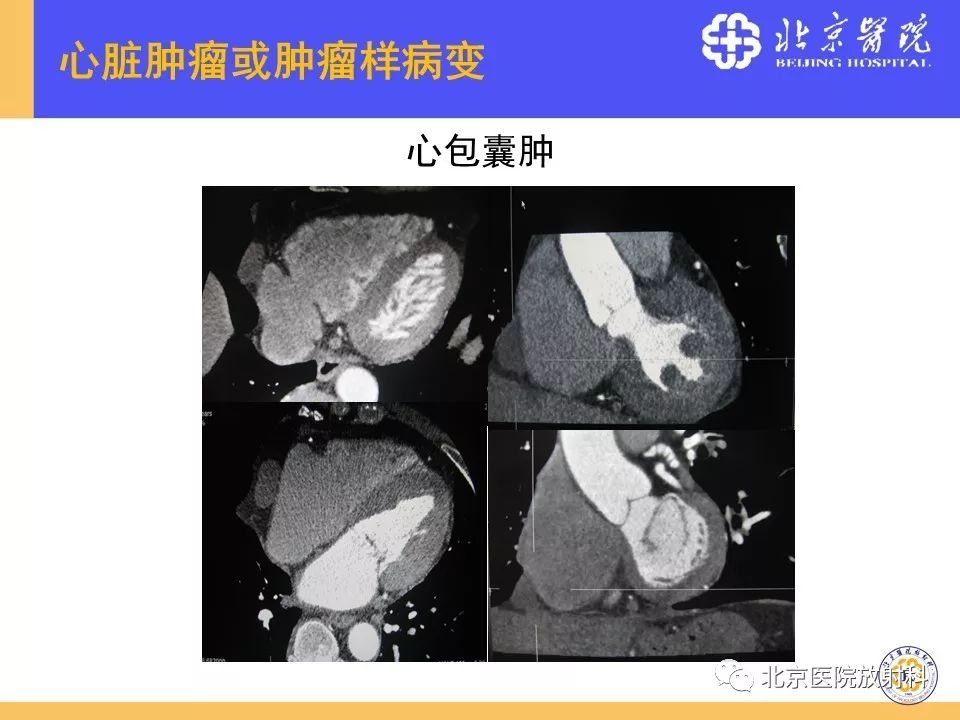 【PPT】心脏病变的影像诊断