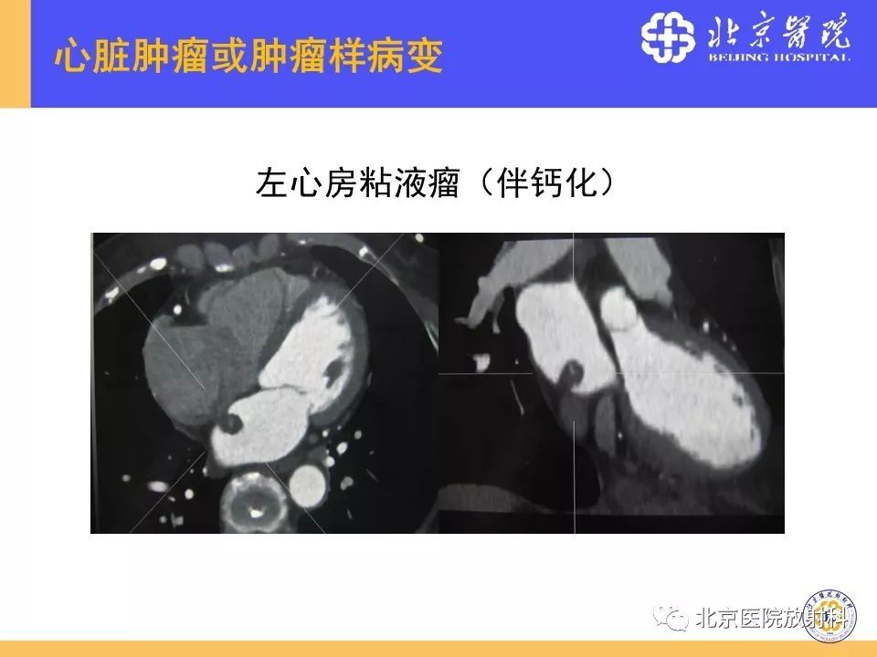【PPT】心脏病变的影像诊断