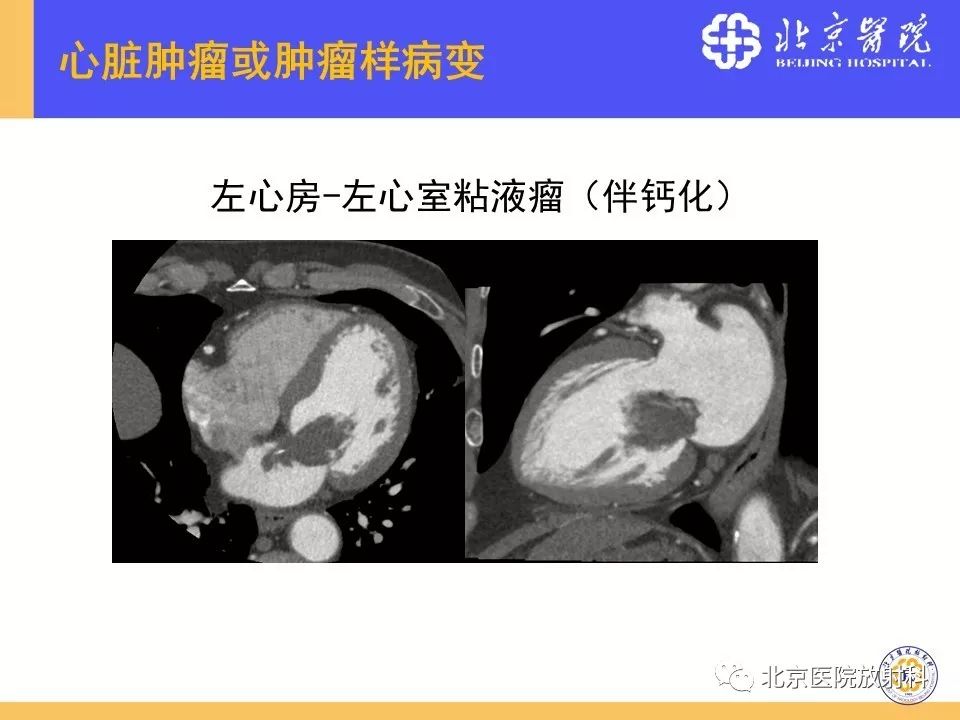 【PPT】心脏病变的影像诊断