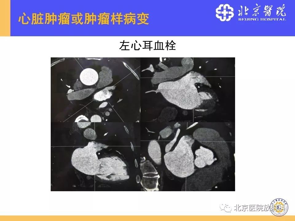 【PPT】心脏病变的影像诊断