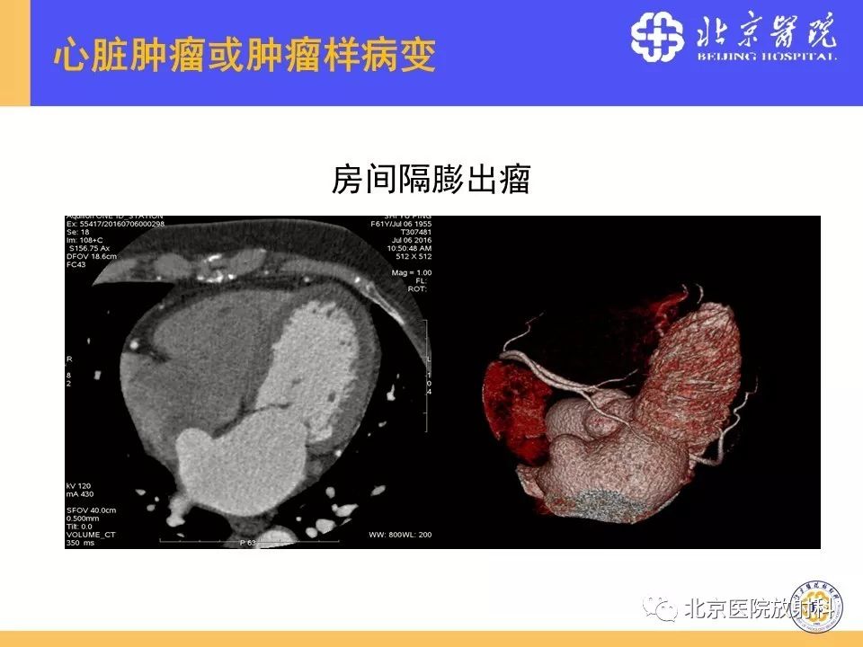 【PPT】心脏病变的影像诊断