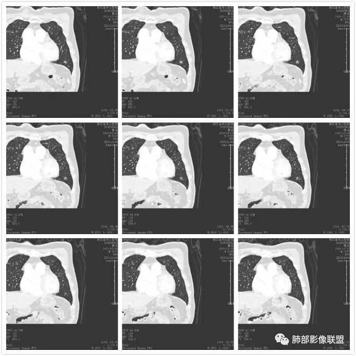 【病例】空泡和胸膜牵拉的价值你清楚吗? 【病例】空泡和胸膜牵拉的价值你清楚吗?