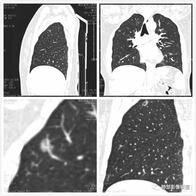 【病例】空泡和胸膜牵拉的价值你清楚吗？