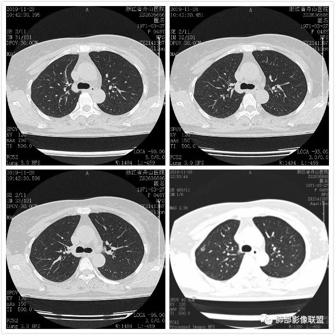 【病例】空泡和胸膜牵拉的价值你清楚吗？