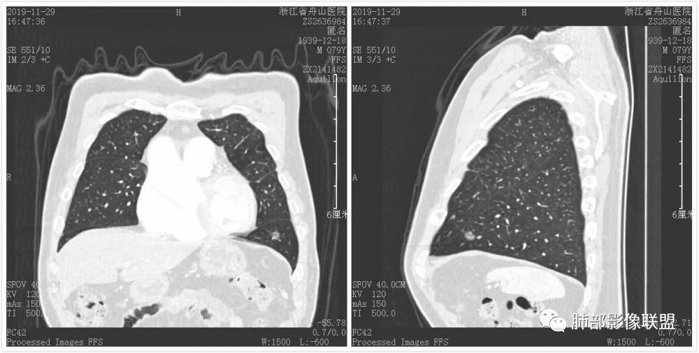 【病例】空泡和胸膜牵拉的价值你清楚吗? 【病例】空泡和胸膜牵拉的价值你清楚吗?