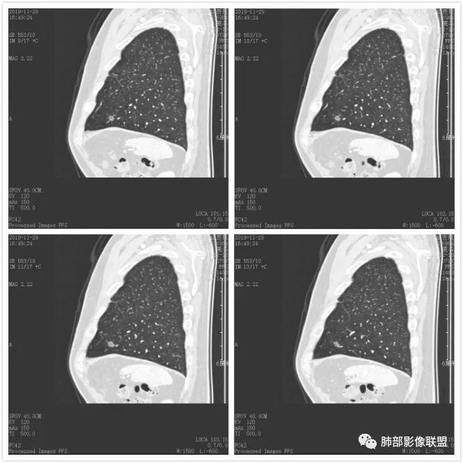 【病例】空泡和胸膜牵拉的价值你清楚吗? 【病例】空泡和胸膜牵拉的价值你清楚吗?