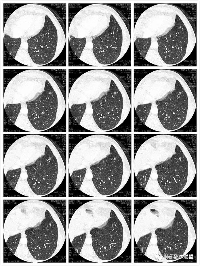【病例】空泡和胸膜牵拉的价值你清楚吗？
