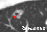 【病例】空泡和胸膜牵拉的价值你清楚吗？