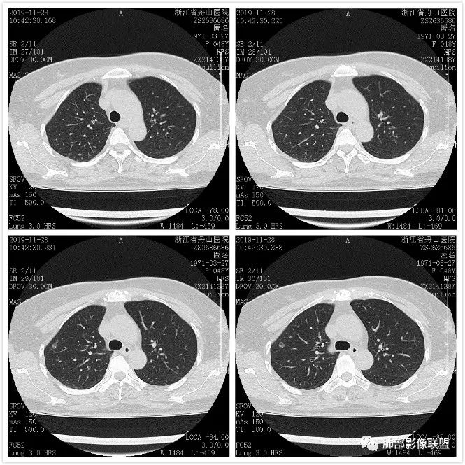 【病例】空泡和胸膜牵拉的价值你清楚吗？