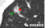 【病例】空泡和胸膜牵拉的价值你清楚吗？