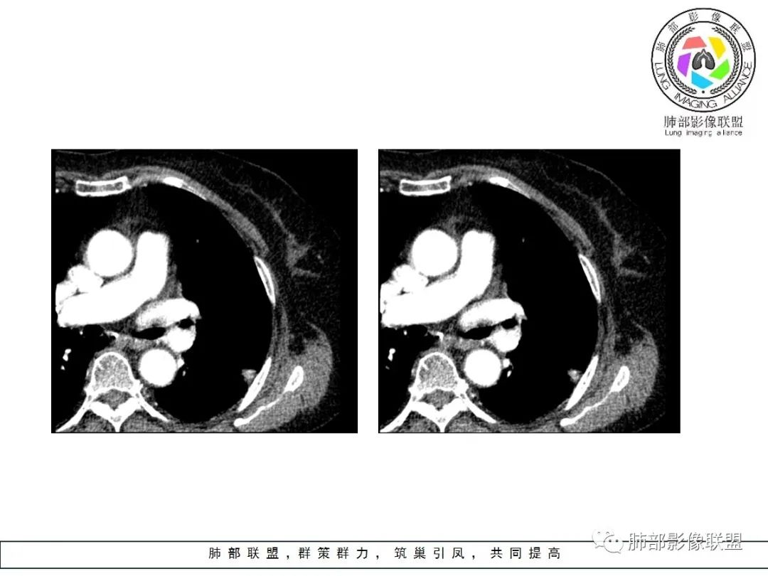 【病例】小征象大用途---脐凹征