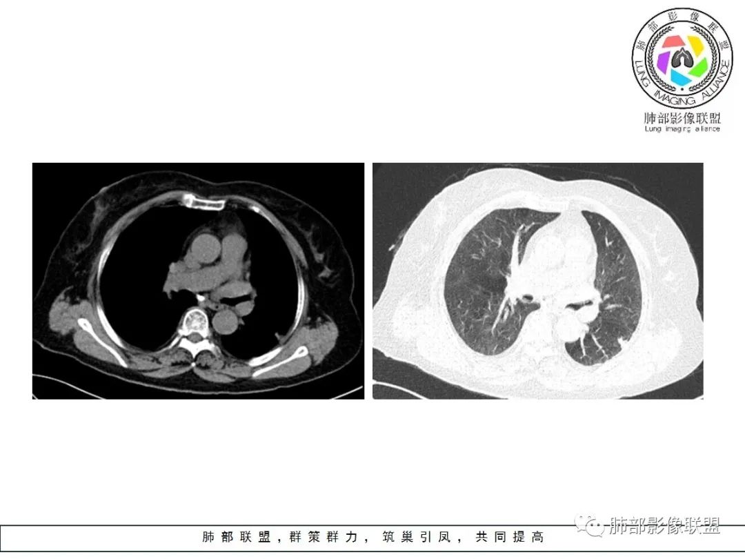 【病例】小征象大用途---脐凹征