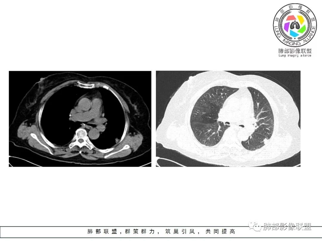【病例】小征象大用途---脐凹征
