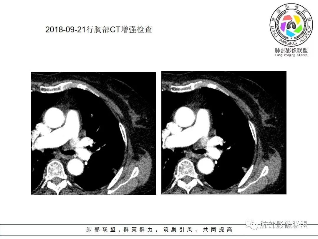 【病例】小征象大用途---脐凹征