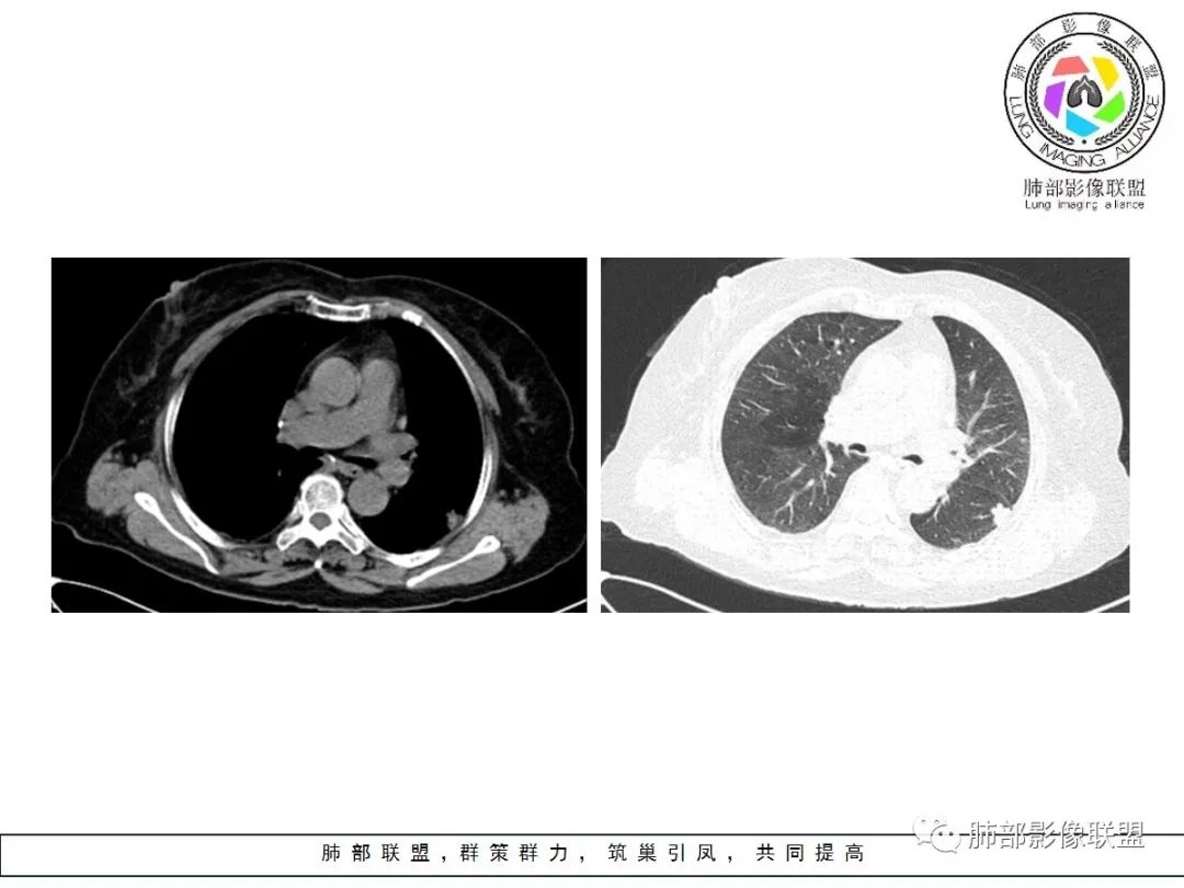 【病例】小征象大用途---脐凹征