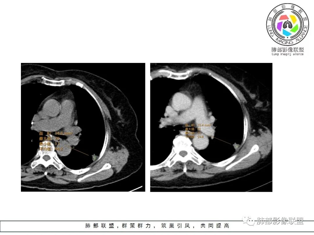 【病例】小征象大用途---脐凹征