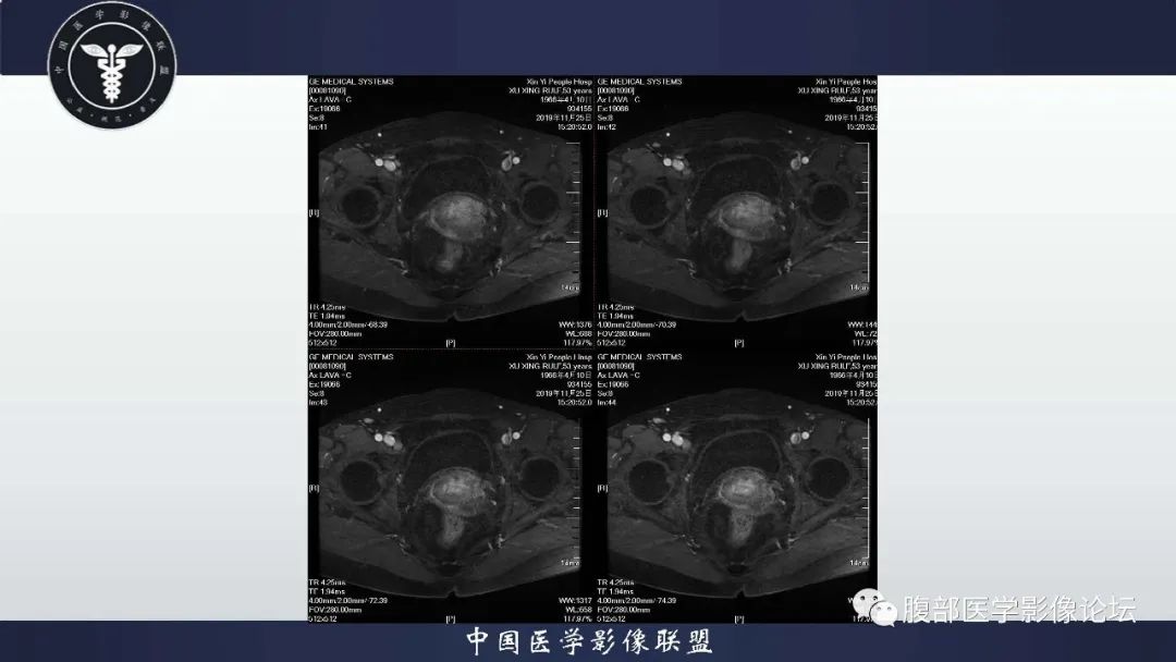 【病例】子宫内膜息肉1例MR影像