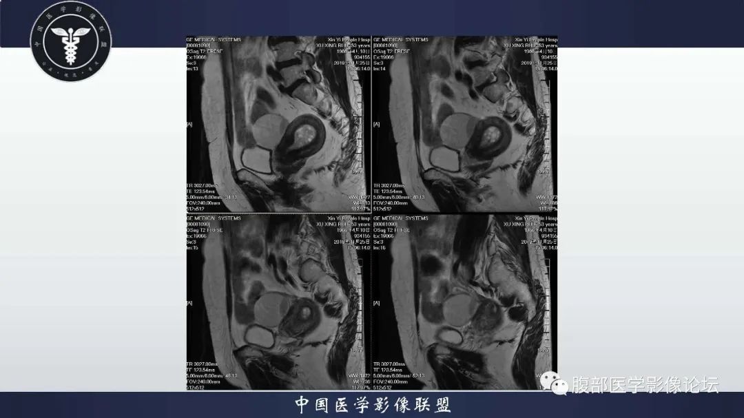 【病例】子宫内膜息肉1例MR影像