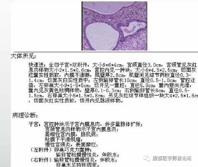 【病例】子宫内膜息肉1例MR影像