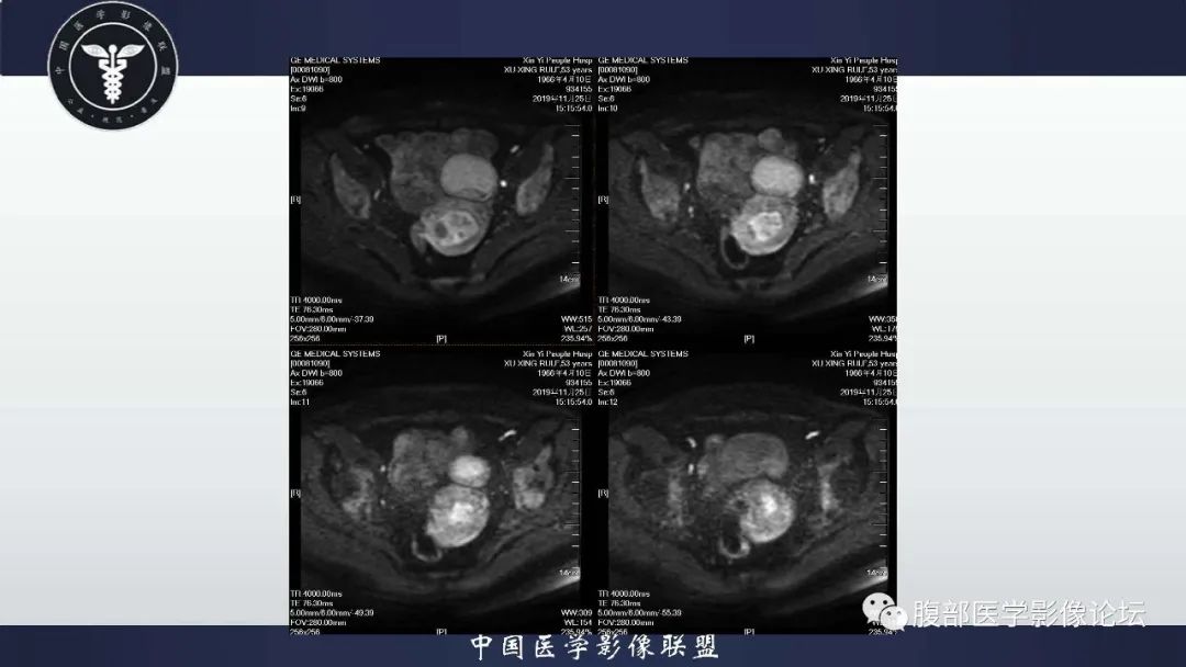【病例】子宫内膜息肉1例MR影像