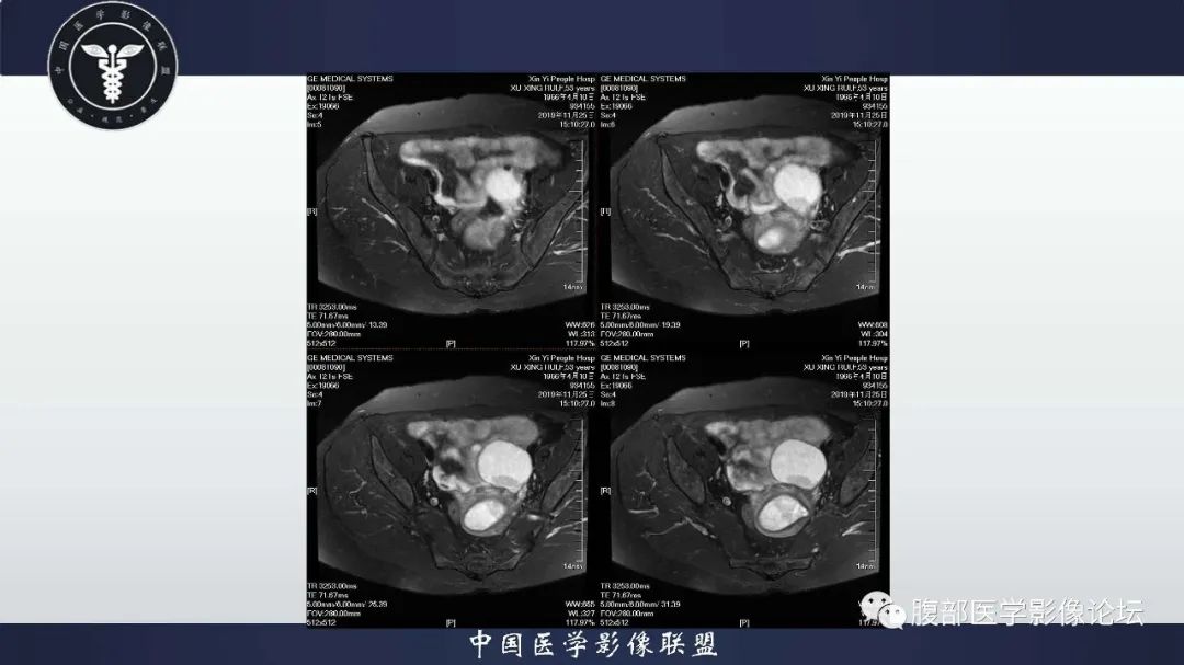 【病例】子宫内膜息肉1例MR影像