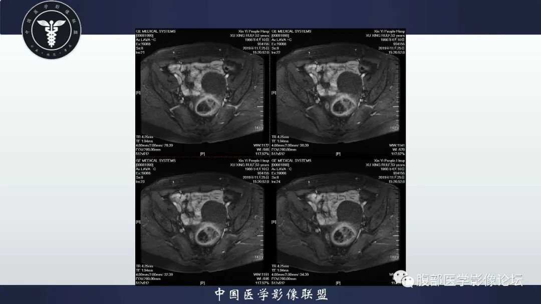【病例】子宫内膜息肉1例MR影像