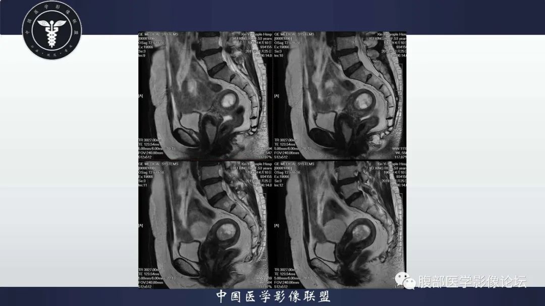 【病例】子宫内膜息肉1例MR影像