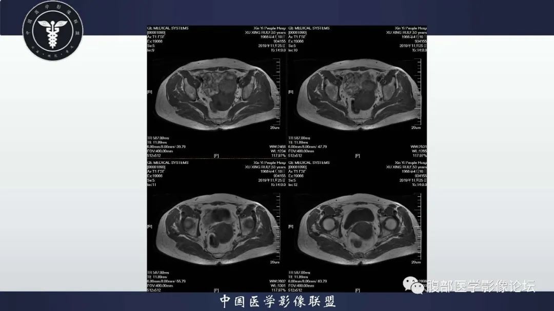 【病例】子宫内膜息肉1例MR影像