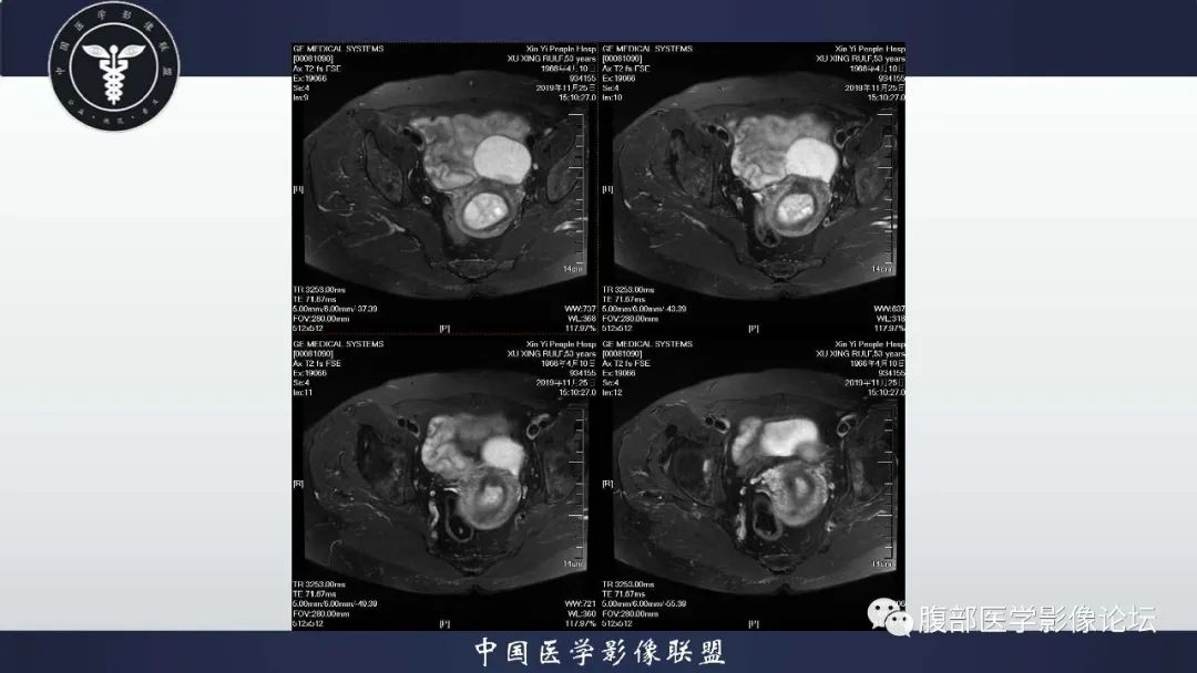 【病例】子宫内膜息肉1例MR影像
