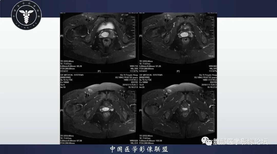 【病例】子宫内膜息肉1例MR影像