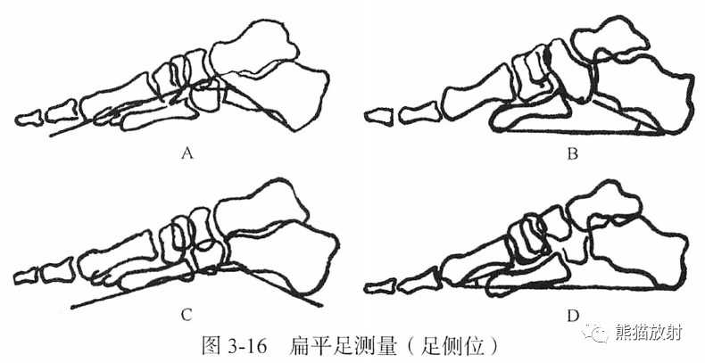 骨关节画线及测量