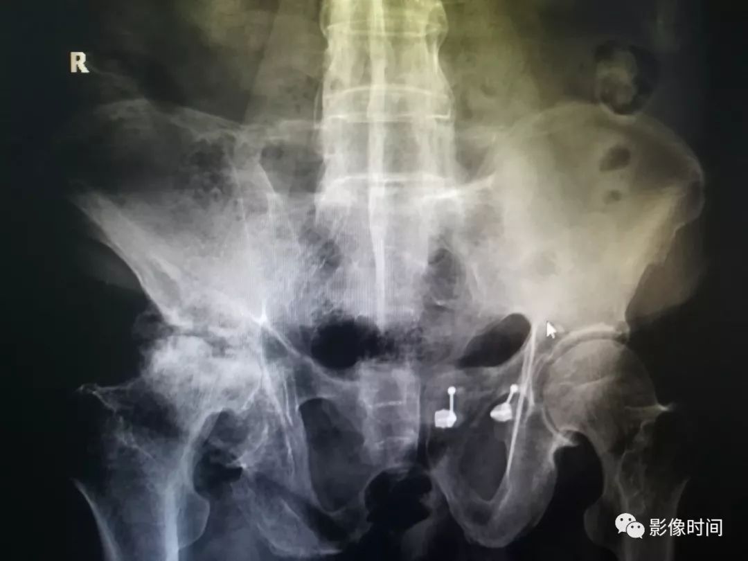 强直性脊柱炎的影像
