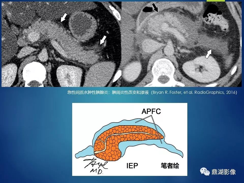 【PPT】急性胰腺炎2012新亚特兰大分类：影像科医生需知道什么